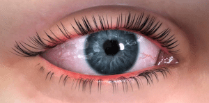Dry eye